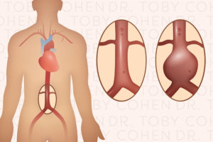 aortic aneurysm aneurysms