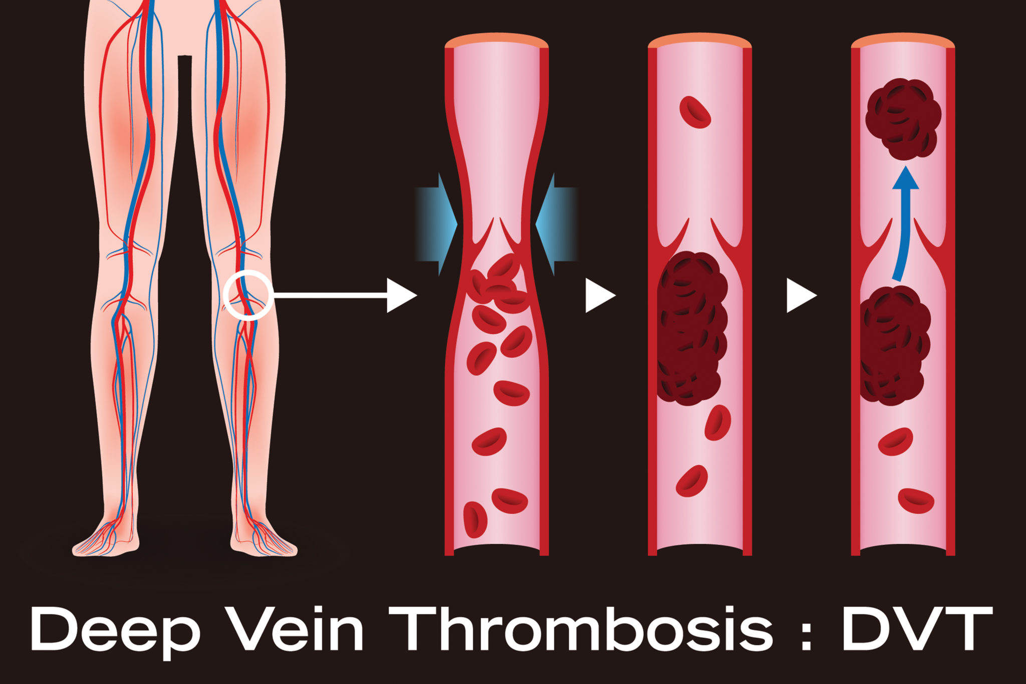 Secondary Elasticity Venous Thrombosis Varicose Compression