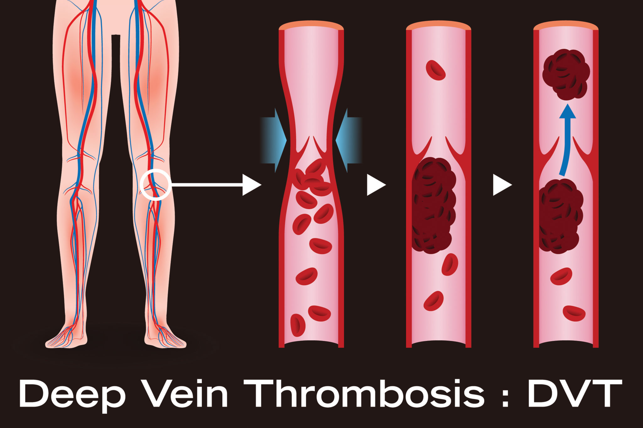 Compression Stockings and Long Flights - Dr Toby Cohen