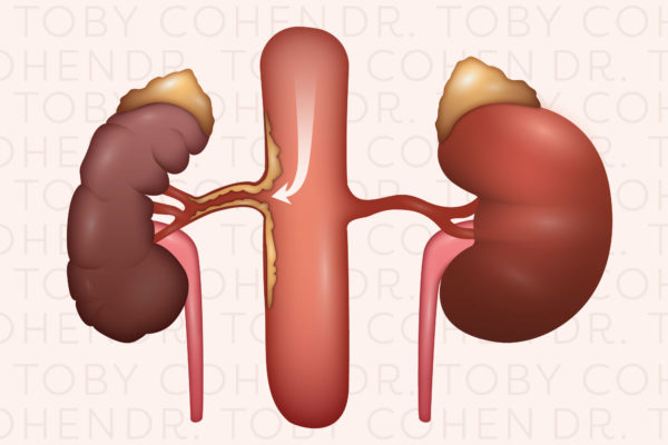 Renal-and-visceral-artery_02
