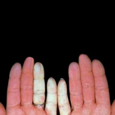 Hammer Syndrome